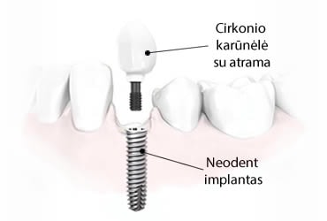Danties implanto kaina