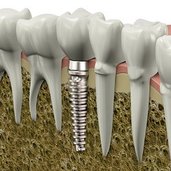 Dantų implantų komplikacijos