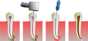 Dantų šaknų kanalų gydymas – Endodontija