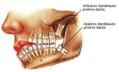 Protinių dantų traukimas (šalinimas)
